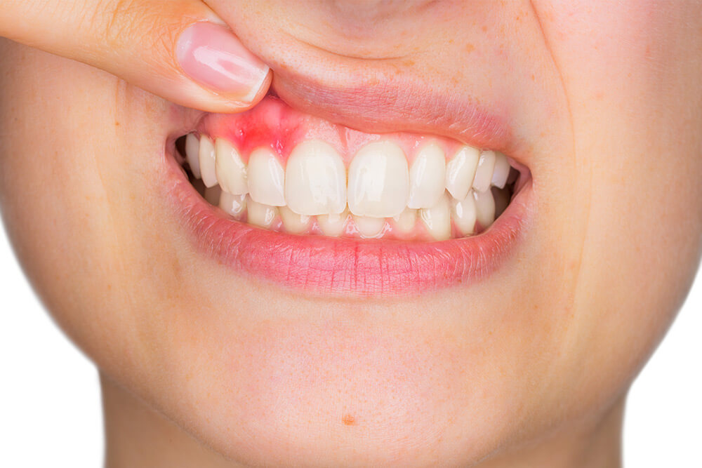Eine Frau zeigt ihr entzündetes Zahnfleisch.
